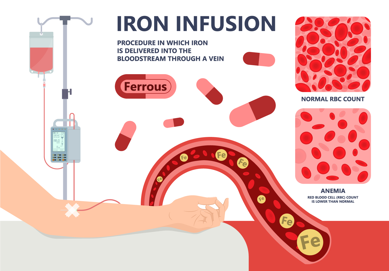 IV iron quickly alleviates anemia
