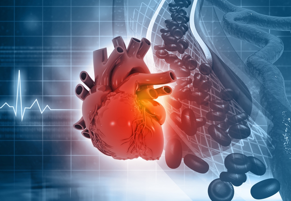 Intravenous iron therapy improves outcomes for chronic heart failure
